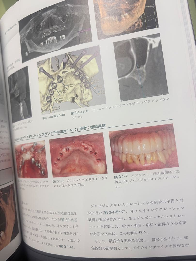 CAD/CAM時代の最新インプラント上部構造