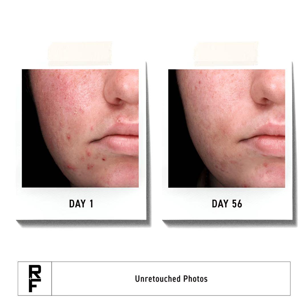 【新品】RODAN + FIELDS SPOTLESS セット ロダンフィールズ