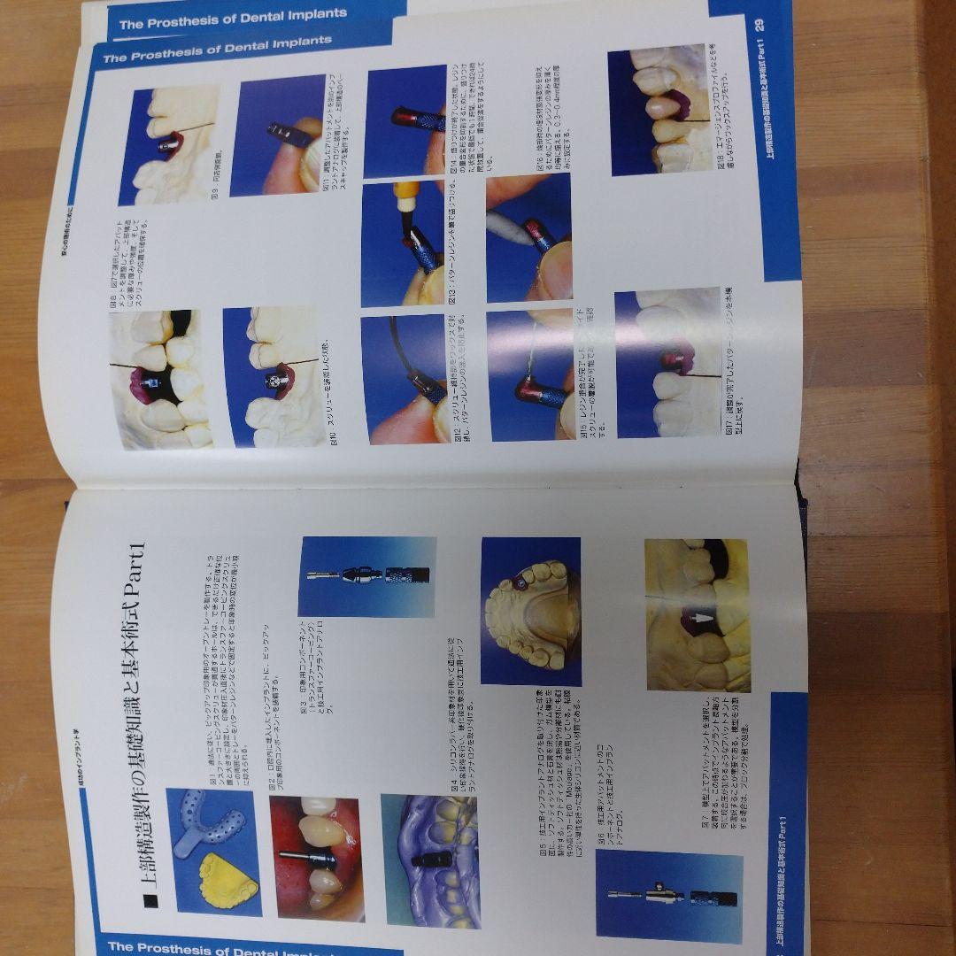 成功のインプラント学