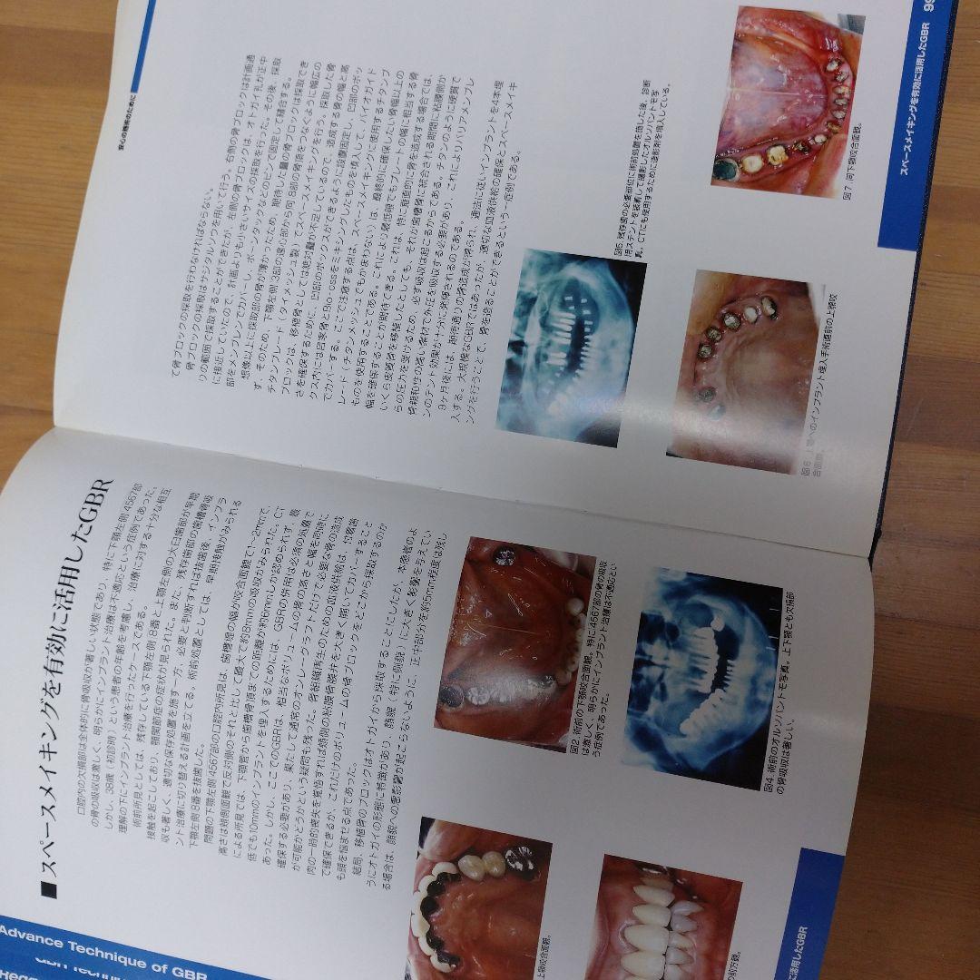 成功のインプラント学