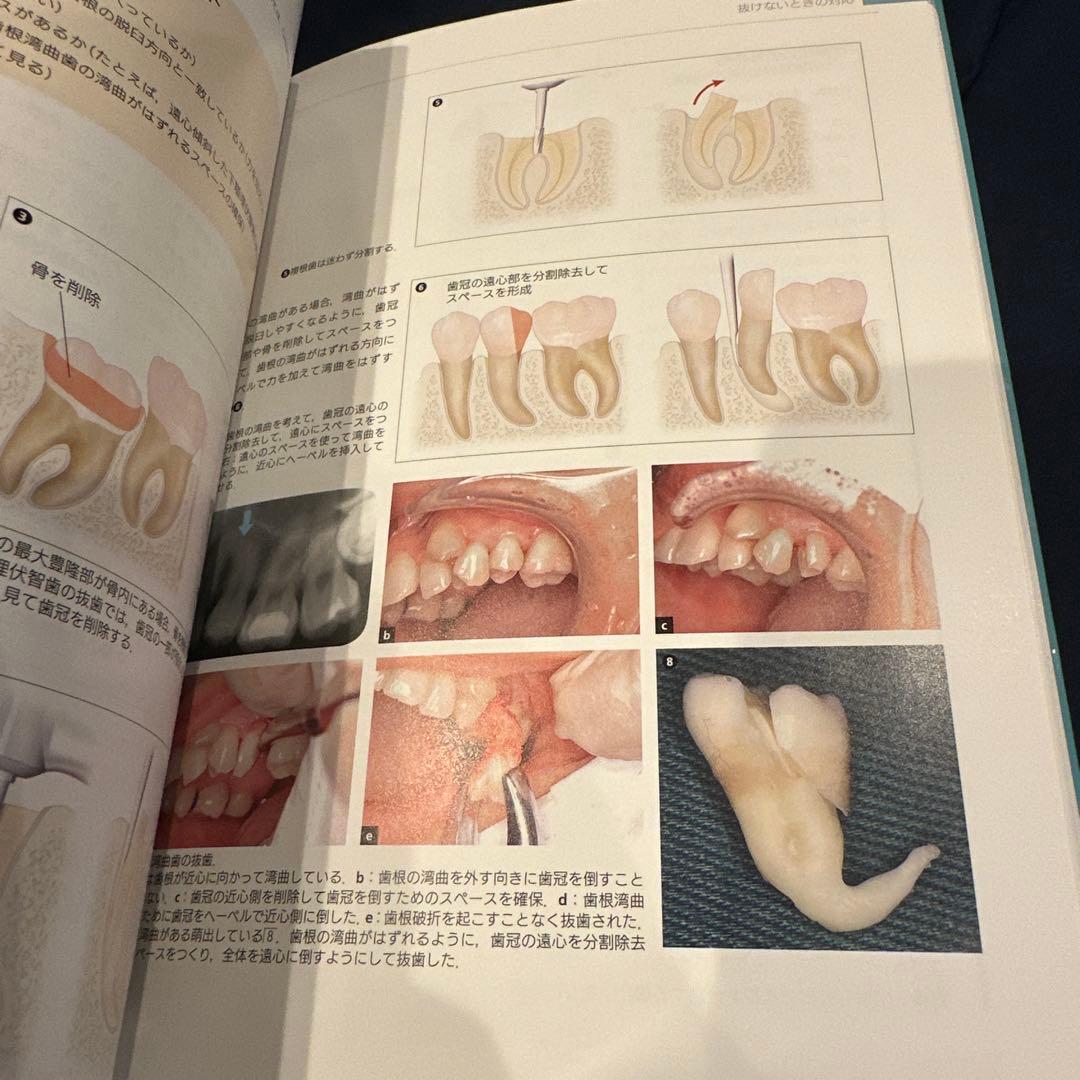 必ず上達 抜歯手技 増補新版　最終値下げ