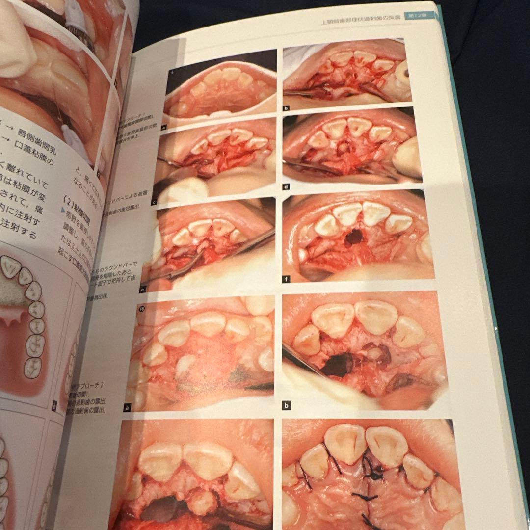 必ず上達 抜歯手技 増補新版　最終値下げ