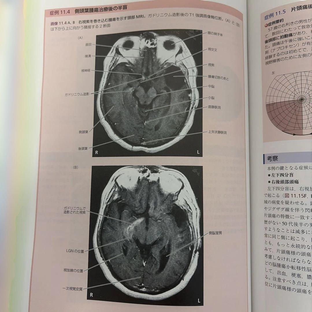 【帯付き未使用】ブルーメンフェルト カラー神経解剖学 臨床例と画像鑑別診断