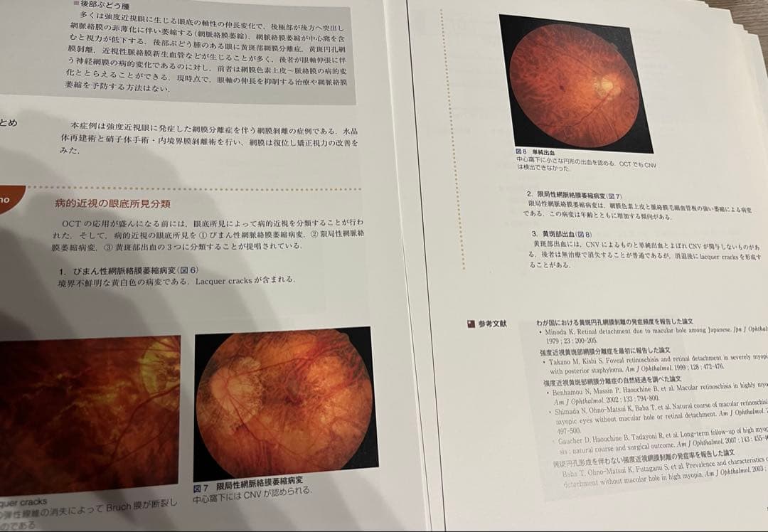 眼科ケーススタディ 網膜硝子体(裁断済み)